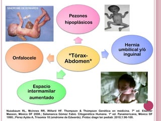 Pezones
                                       hipoplásicos




                                                                               Hernia
                                                                            umbilical y/ó
                                        *Tórax-                               inguinal
    Onfalocele
                                       Abdomen*



                 Espacio
              intermamilar
               aumentado

Nussbaum RL, Mcinnes RR, Willard HF. Thompson & Thompson Genética en medicina. 7ª ed. Elsevier
Masson, México DF 2008.; Salamanca Gómez Fabio. Citogenética Humana. 1ª ed. Panamericana, México DF
1990.; Pérez Aytés A, Trisomía 18 (síndrome de Edwards). Protoc diagn ter pediatr. 2010;1:96-100.
 