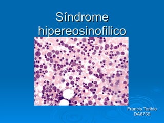 Síndrome hipereosinofilico Francis Toribio DA6739 