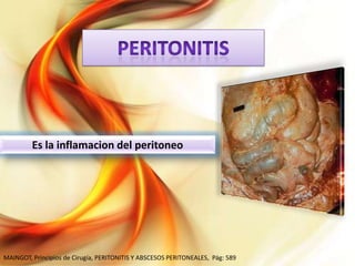 Es la inflamacion del peritoneo

MAINGOT, Principios de Cirugía, PERITONITIS Y ABSCESOS PERITONEALES, Pág: 589

 