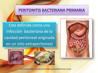 Esta definida como una
infección bacteriana de la
cavidad peritoneal originada
en un sitio extraperitoneal

Intramed: http://www.intramed.net/sitios/librovirtual1/pdf/librovirtual1_42.pdf

 