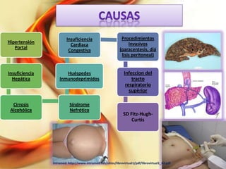 Hipertensión
Portal

Insuficiencia
Cardiaca
Congestiva

Procedimientos
Invasivos
(paracentesis, diá
lisis peritoneal)

Insuficiencia
Hepática

Huéspedes
Inmunodeprimidos

Infeccion del
tracto
respiratorio
supèrior

Cirrosis
Alcohólica

Síndrome
Nefrótico

SD Fitz-HughCurtis

Intramed: http://www.intramed.net/sitios/librovirtual1/pdf/librovirtual1_42.pdf

 