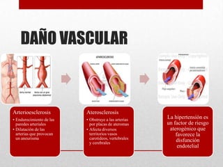 DAÑO VASCULAR
Arterioesclerosis
• Endurecimiento de las
paredes arteriales
• Dilatación de las
arterias que provocan
un aneurisma
Aterosclerosis
• Obstruye a las arterias
por placas de ateromas
• Afecta diversos
territorios vasos
carotideos, vertebrales
y cerebrales
La hipertensión es
un factor de riesgo
aterogénico que
favorece la
disfunción
endotelial
 