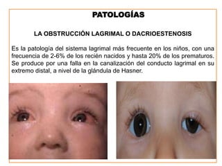 PATOLOGÍAS
LA OBSTRUCCIÓN LAGRIMAL O DACRIOESTENOSIS
Es la patología del sistema lagrimal más frecuente en los niños, con una
frecuencia de 2-6% de los recién nacidos y hasta 20% de los prematuros.
Se produce por una falla en la canalización del conducto lagrimal en su
extremo distal, a nivel de la glándula de Hasner.
 