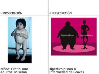HIPOSECRECIÓN HIPERSECRECIÓN
Niños: Cretinismo.
Adultos: Mixema
Hipertiroidismo o
Enfermedad de Graves
 