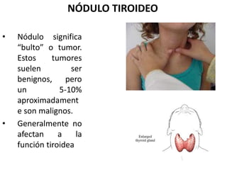 NÓDULO TIROIDEO
• Nódulo significa
“bulto” o tumor.
Estos tumores
suelen ser
benignos, pero
un 5-10%
aproximadament
e son malignos.
• Generalmente no
afectan a la
función tiroidea
 
