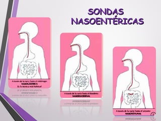 SONDASSONDAS
NASOENTÉRICASNASOENTÉRICAS
 