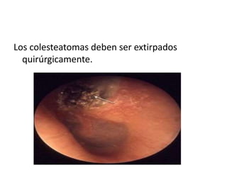 Los colesteatomas deben ser extirpados
quirúrgicamente.
 