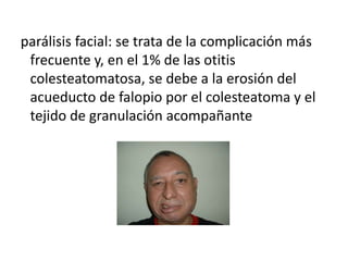parálisis facial: se trata de la complicación más
frecuente y, en el 1% de las otitis
colesteatomatosa, se debe a la erosión del
acueducto de falopio por el colesteatoma y el
tejido de granulación acompañante
 