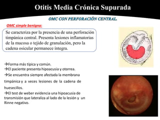 Otitis Media Crónica Supurada
Se caracteriza por la presencia de una perforación
timpánica central. Presenta lesiones inflamatorias
de la mucosa o tejido de granulación, pero la
cadena osicular permanece íntegra.
OMC simple benigna:
Forma más típica y común.
El paciente presenta hipoacusia y otorrea.
Se encuentra siempre afectada la membrana
timpánica y a veces lesiones de la cadena de
huesecillos.
El test de weber evidencia una hipoacusia de
transmisión que lateraliza al lado de la lesión y un
Rinne negativo.
 
