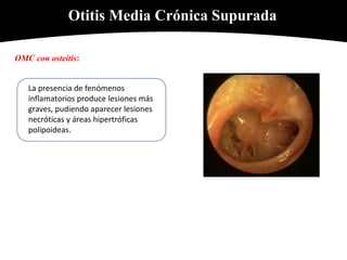 Otitis Media Crónica Supurada
OMC con osteítis:
La presencia de fenómenos
inflamatorios produce lesiones más
graves, pudiendo aparecer lesiones
necróticas y áreas hipertróficas
polipoideas.
 