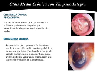 Otitis Media Crónica con Tímpano Integro.
:
Proceso inflamatorio del oído con tendencia a
la fibrosis y adherencia timpánica por
alteraciones del sistema de ventilación del oído
medio.
.
Se caracteriza por la presencia de líquido no
purulento en el oído medio, con integridad de la
membrana timpánica. Este líquido puede ser de
aspecto mucoso, seroso o una combinación de
ambos, pudiendo variar en su composición a lo
largo de la evolución de la enfermedad.
 