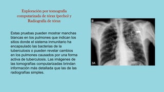 Exploración por tomografía
computarizada de tórax (pecho) y
Radiografía de tórax
Estas pruebas pueden mostrar manchas
blancas en los pulmones que indican los
sitios donde el sistema inmunitario ha
encapsulado las bacterias de la
tuberculosis o pueden revelar cambios
en los pulmones causados por una forma
activa de tuberculosis. Las imágenes de
las tomografías computarizadas brindan
información más detallada que las de las
radiografías simples.
 