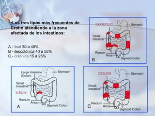 A -  ileal  30 a 40% B -  ileocolónica  40 a 55% C -  colónica  15 a 25% Los tres tipos más frecuentes de Crohn atendiendo a la zona afectada de los intestinos:  