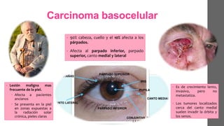 Carcinoma basocelular
• Lesión maligna mas
frecuente de la piel.
 Afecta a pacientes
ancianos
 Se presenta en la piel
en zonas expuestas a
la radiación solar
crónica, pieles claras
• 90% cabeza, cuello y el 10% afecta a los
párpados.
• Afecta al parpado inferior, parpado
superior, canto medial y lateral
• Es de crecimiento lento,
invasivo, pero no
metastatiza.
• Los tumores localizados
cerca del canto medial
suelen invadir la órbita y
los senos.
 