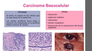 Histología:
• El tumor se origina en las células que
la capa basal de la epidermis.
• Las células proliferan hacia abajo y
mostrar una empalizada en la periferia
lóbulo tumoral de células.
Clínica:
• Ulceración
• palpación indolora
• Induración
• bordes irregulares
• destrucción de la arquitectura del borde
palpebral.
Carcinoma Basocelular
 
