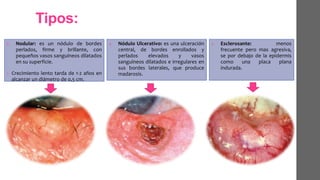 Tipos:
1. Nodular: es un nódulo de bordes
perlados, firme y brillante, con
pequeños vasos sanguíneos dilatados
en su superficie.
• Crecimiento lento tarda de 1-2 años en
alcanzar un diámetro de 0,5 cm.
1. Nódulo Ulcerativo: es una ulceración
central, de bordes enrollados y
perlados elevados y vasos
sanguíneos dilatados e irregulares en
sus bordes laterales, que produce
madarosis.
1. Esclerosante: menos
frecuente pero mas agresiva,
se por debajo de la epidermis
como una placa plana
indurada.
 