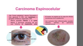 Carcinoma Espinocelular
• 2do Tumor palpebral, menos frecuente y
más agresivo 5-10%, con metástasis a
ganglios linfáticos regionales 20%
 Afecta parpado inferior y el canto
 Afecta a personas ancianas de tez
una historia de exposición solar
• El tumor se origina en la capa de células
escamosas de la epidermis.
• Los tumores bien diferenciados pueden
mostrar «perlas» de queratina
características.
 