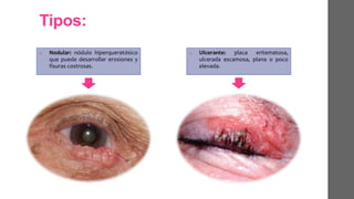 Tipos:
1. Nodular: nódulo hiperqueratósico
que puede desarrollar erosiones y
fisuras costrosas.
1. Ulcerante: placa eritematosa,
ulcerada escamosa, plana o poco
elevada.
 