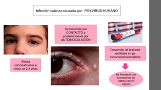 Infección cutánea causada por: POXVIRUS HUMANO
Afecta
principalmente a
niños de 2-4 años
Se transmite por
CONTACTO y
posteriormente por
AUTOINOCULACIÓN
Desarrollo de lesiones
múltiples en px
inmunocomprometidos
Es frecuente que
las lesiones se
distribuyan en
mentón
 
