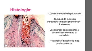 Histología:
-Lóbulos de epitelio hiperplásico
- Cuerpos de inclusión
intracitoplasmáticos (Henderson-
Patterson)
-Los cuerpos son pequeños y
eosinofílicos cerca de la
superficie
-Y grandes y basofílicos más
profundamente
 