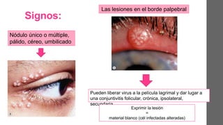 Signos:
Nódulo único o múltiple,
pálido, céreo, umbilicado
Las lesiones en el borde palpebral
Pueden liberar virus a la película lagrimal y dar lugar a
una conjuntivitis folicular, crónica, ipsolateral,
secundaria.
Exprimir la lesión
=
material blanco (cél infectadas alteradas)
 