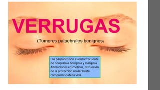 VERRUGAS
(Tumores palpebrales benignos)
Los párpados son asiento frecuente
de neoplasias benignas y malignas
Alteraciones cosméticas, disfunción
de la protección ocular hasta
compromiso de la vida.
 