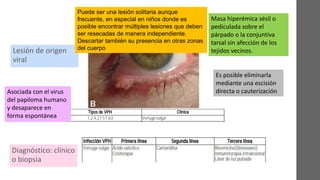 Verruga Vulgar
Lesión de origen
viral
Masa hiperémica sésil o
pediculada sobre el
párpado o la conjuntiva
tarsal sin afección de los
tejidos vecinos.
Asociada con el virus
del papiloma humano
y desaparece en
forma espontánea
Es posible eliminarla
mediante una escisión
directa o cauterización
Diagnóstico: clínico
o biopsia
Puede ser una lesión solitaria aunque
frecuente, en especial en niños donde es
posible encontrar múltiples lesiones que deben
ser resecadas de manera independiente.
Descartar también su presencia en otras zonas
del cuerpo
 
