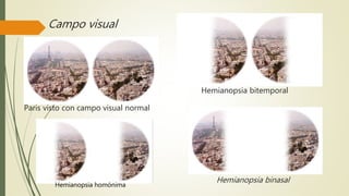 Campo visual
Paris visto con campo visual normal
Hemianopsia bitemporal
Hemianopsia binasal
Hemianopsia homónima
 