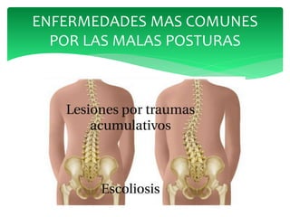 ENFERMEDADES MAS COMUNES
POR LAS MALAS POSTURAS
 