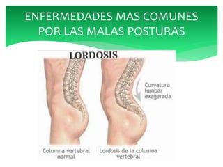 ENFERMEDADES MAS COMUNES
POR LAS MALAS POSTURAS
 
