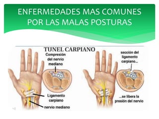 ENFERMEDADES MAS COMUNES
POR LAS MALAS POSTURAS
 