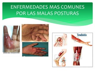 ENFERMEDADES MAS COMUNES
POR LAS MALAS POSTURAS
 