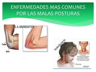 ENFERMEDADES MAS COMUNES
POR LAS MALAS POSTURAS
 