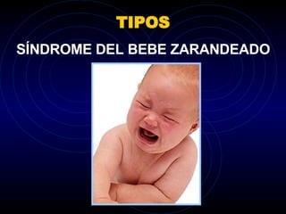 TIPOS SÍNDROME DEL BEBE ZARANDEADO 