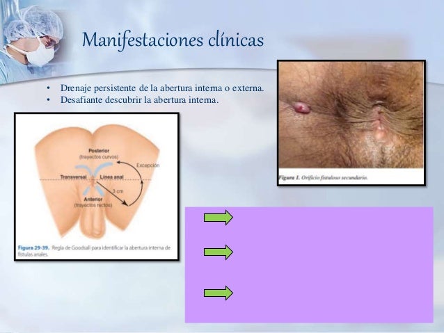 RECTO Y ANO : Abscesos Fístulas y Enfermedad Pilonidal