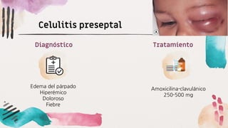 Edema del párpado
Hiperémico
Doloroso
Fiebre
Diagnóstico
Amoxicilina-clavulánico
250-500 mg
Tratamiento
Celulitis preseptal
 