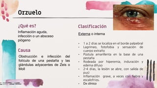 Orzuelo
Inflamación aguda,
infección o un absceso
piógeno
¿Qué es?
Obstrucción e infección del
folículo de una pestaña y las
glándulas adyacentes de Zeis o
Moll
Causa
Externa o interna
Clasificación
• 1 a 2 días se localiza en el borde palpebral
• Lagrimeo, fotofobia y sensación de
cuerpo extraño
• Pústula amarillenta en la base de una
pestaña
• Rodeada por hiperemia, induración y
edema difuso
• 2-4 días, la lesión se abre, con salida de
pus)
• Inflamación grave, a veces con fiebre y
escalofríos.
• Dx clínico
 