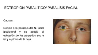 ECTROPIÓN PARALÍTICO/ PARALÍSIS FACIAL
Causas:
Debido a la parálisis del N. facial
ipsolateral y se asocia al
ectropión de los párpados sup e
inf y a ptosis de la ceja
 