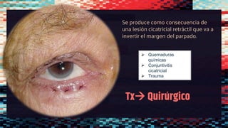Tx→ Quirúrgico
Se produce como consecuencia de
una lesión cicatricial retráctil que va a
invertir el margen del parpado.
➢ Quemaduras
químicas
➢ Conjuntivitis
cicatricial
➢ Trauma
 