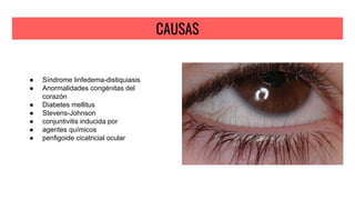 CAUSAS
● Síndrome linfedema-distiquiasis
● Anormalidades congénitas del
corazón
● Diabetes mellitus
● Stevens-Johnson
● conjuntivitis inducida por
● agentes químicos
● penfigoide cicatricial ocular
 