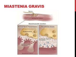 MIASTENIA GRAVIS
 