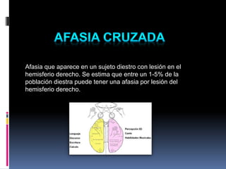 Afasia que aparece en un sujeto diestro con lesión en el
hemisferio derecho. Se estima que entre un 1-5% de la
población diestra puede tener una afasia por lesión del
hemisferio derecho.
 