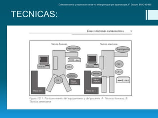 Colecistectomía y exploración de la vía biliar principal por laparoscopia, F. Dubois, EMC 40-950
NEUMOPERITONEO
 Previa i...