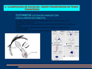 4.- CLASIFICACION DE COLGAJOS : SEGÚN TRANSPOSICION DE TEJIDO
                  TRANSFERIDO

         •
             CUTANEOS (COLGAJOS AXIALES CON
         VASCULARIZACION DIRECTA)
          -COLGAJO FRONTAL BASADO ART.SUPRAORBITARIA O RAMA FRONTAL DE LA
         ART.FRONTAL SUPERFICIAL.
         -COLGAJO DELTOPECTORAL BASADO EN LA 2DA 3ERA PERFORANTE DE LA TORAXICA
         INTERNA
         -COLGAJO AXOLAR TORACODORSAL BASADO EN LA RAMA CUTANEA DEL EJE
         TORACOACROMIAL.
         -COLGAJO DORSAL DEL PIE BASADO EN LA ART.DORSAL DEL PIE ETC
 