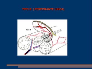 TIPO B ( PERFORANTE UNICA)
 