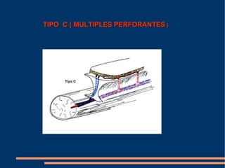 TIPO C ( MULTIPLES PERFORANTES )
 