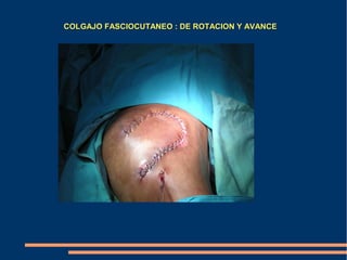 COLGAJO FASCIOCUTANEO : DE ROTACION Y AVANCE
 