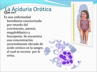 La es?
Que
    Aciduria Orótica
Es una enfermedad
  hereditaria caracterizada
  por retardo del
  crecimiento, anemia
  megaloblástica y
  leucopenia. Se encuentra
  una concentración
  anormalmente elevada de
  ácido orótico en la sangre,
  el cual se excreta por la
  orina.
 