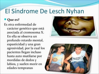 El Síndrome De Lesch Nyhan
Que es?
Es otra enfermedad de
  carácter genético que está
  asociada al cromosoma X.
  En ella se observa un
  profundo retardo mental,
  espasticidad y una gran
  agresividad, por la cual los
  pacientes llegan incluso
  hasta auto mutilarse por
  mordidas de dedos y
  labios, y suelen morir en
  edades tempranas
 