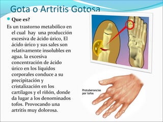 Gota o Artritis Gotosa
Que es?
Es un trastorno metabólico en
  el cual hay una producción
  excesiva de ácido úrico, El
  ácido úrico y sus sales son
  relativamente insolubles en
  agua. la excesiva
  concentración de ácido
  úrico en los líquidos
  corporales conduce a su
  precipitación y
  cristalización en los
  cartílagos y el riñón, donde
  da lugar a los denominados
  tofos. Provocando una
  artritis muy dolorosa.
 
